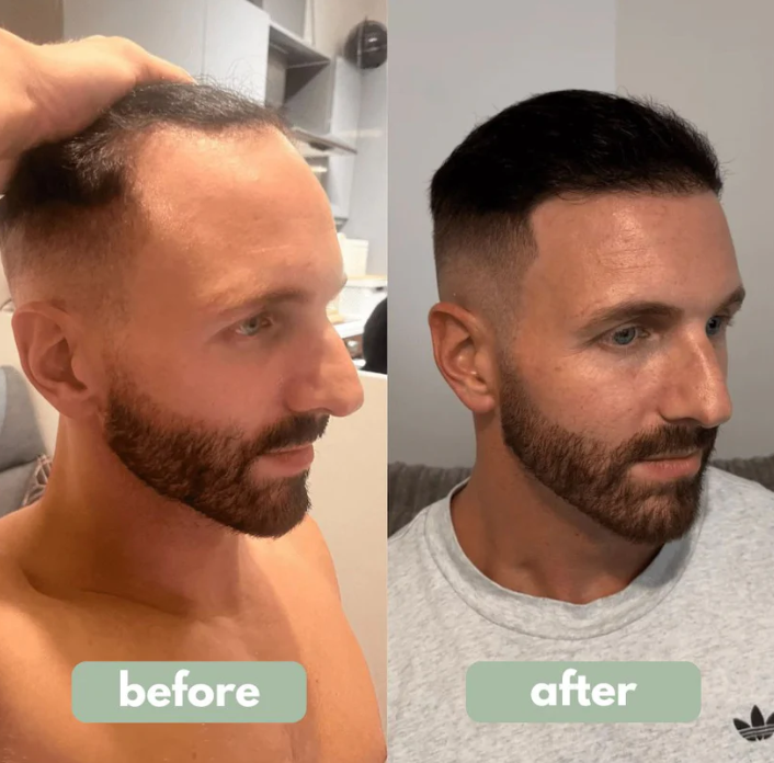 ScalpLab™ Rosemary Hair Revitalizing Serum (Roll-On)